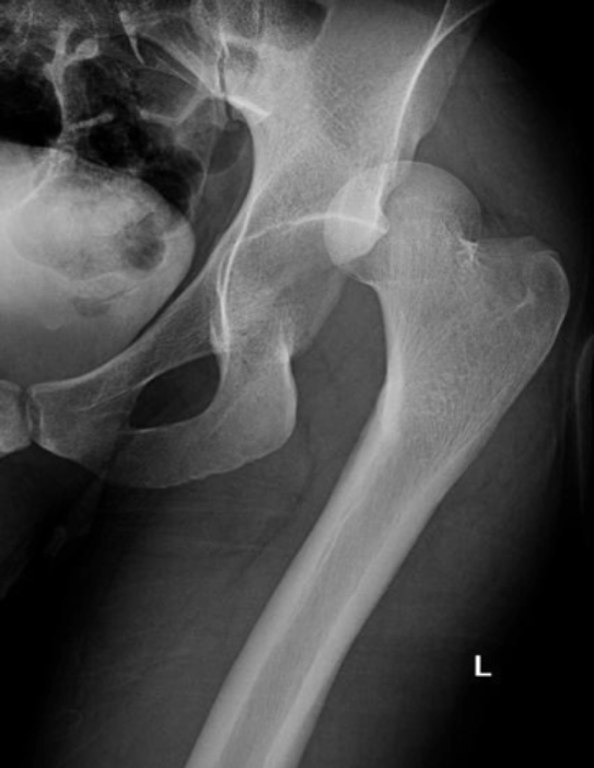 <p>Full dislocation</p>