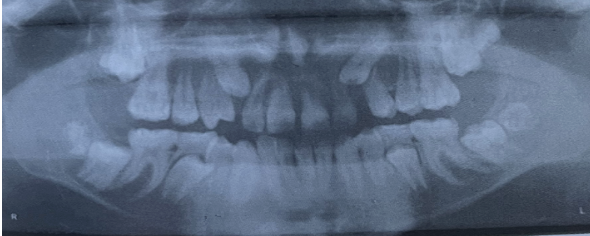 <p><span style="font-family: &quot;Times New Roman&quot;, serif">In this panoramic image, which of the following statements is true?</span></p><ul><li><p><span style="font-family: &quot;Times New Roman&quot;, serif">The permanent mandibular second molars are erupted.</span></p></li><li><p><span style="font-family: &quot;Times New Roman&quot;, serif">There is no evidence of mandibular third molars.</span></p></li><li><p><span style="font-family: &quot;Times New Roman&quot;, serif">Unerupted maxillary canines are present.</span></p></li><li><p><span style="font-family: &quot;Times New Roman&quot;, serif">The primary maxillary first molars are still present.</span></p></li></ul><p></p>