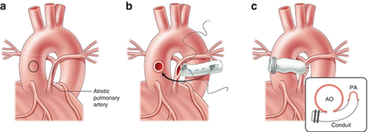 <p>the sole source of blood flow to lungs is from MAPCAs.</p><p>The child needs better flow to small PA to enhance it's growth before ligating the MAPCAs. This is done by creating prosthetic shunt from aorta to PA via sternotomy or by creating a Mee shunt (creating direct anastomosis of tiny PA to the ascending aorta)</p>