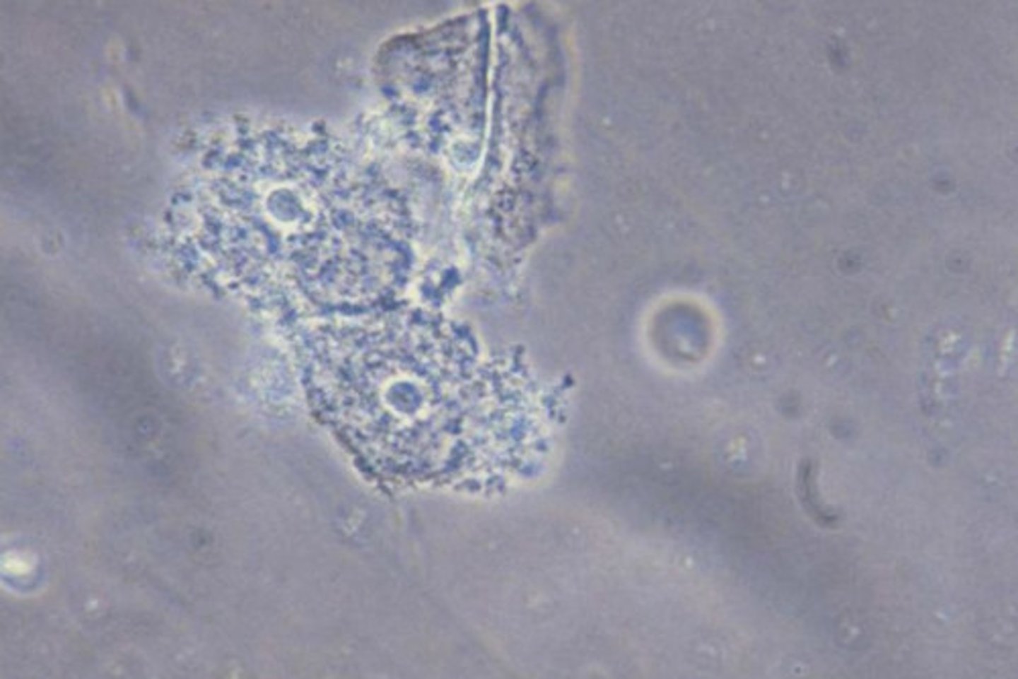 <p>Seen in bacterial vaginosis Vaginal epithelial cells covered w/ bacteria</p>