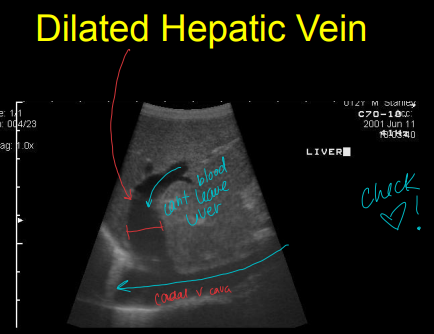 <p>Hepatic Disease on Ultrasound</p>