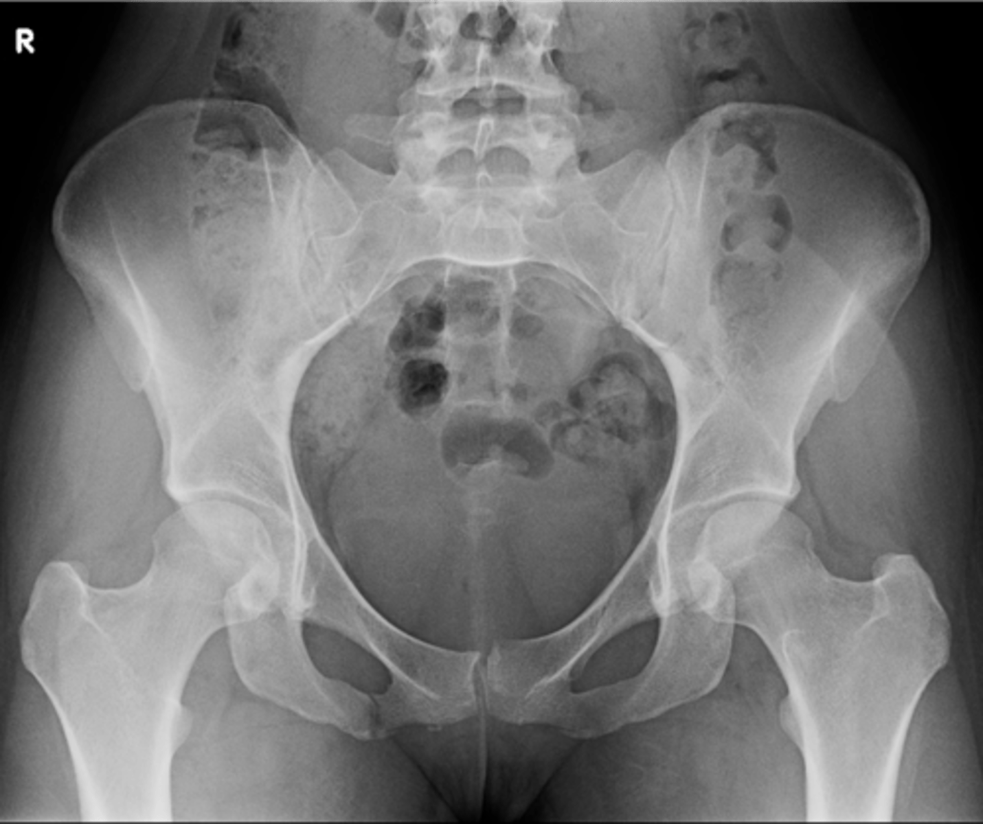 <p>ID standard bilateral pelvis projection</p>