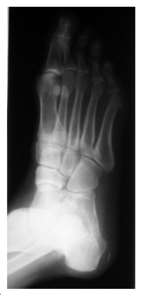 <p>How should the radiographer correct this image of a medial oblique foot?</p><p>a. <span>Dorsiflex foot</span></p><p>b. <span>No correction needed</span></p><p>c. <span>Increase medial rotation</span></p><p>d. <span>Increase angle toward heel</span></p>