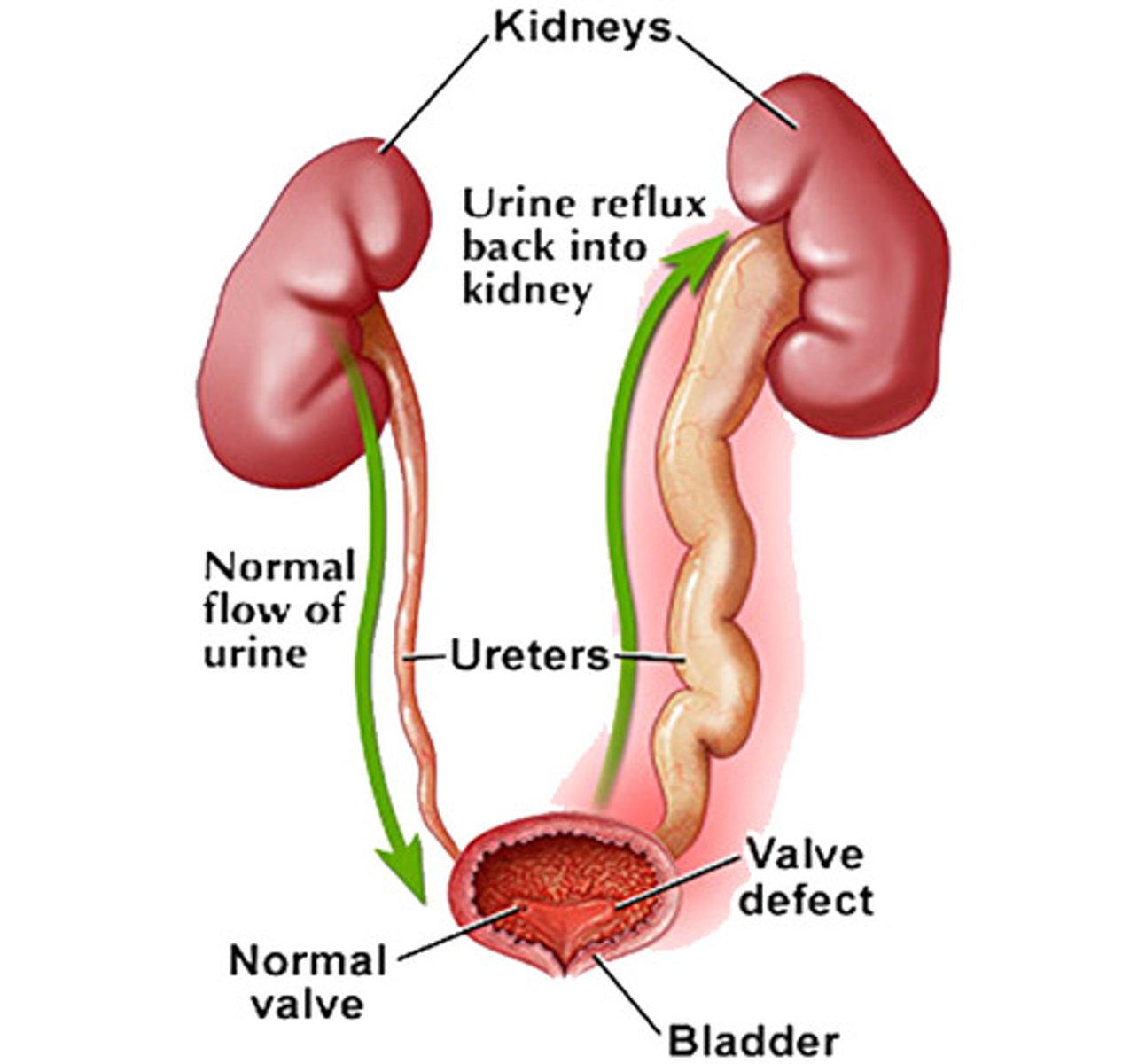 <p>retrograde passage of urine from the bladder into the upper urinary tract</p>