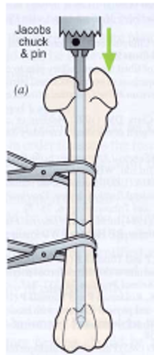 <p>-small skin incision made and pin seated into bone</p><p>-pin positioned in medullary cavity and advanced to just proximal to fracture site, fracture reduced</p><p>-pin pushed into distal fragment</p>