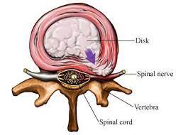 degenerative changes to the intervertebral disc that weakens the disc's outer layers called the annulus
