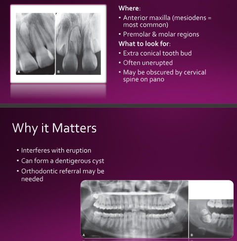<p>Multiple may indicate a syndrome</p><ul><li><p>Gardner’s syndrome&nbsp;</p></li><li><p>Cleidocranial dysplasia&nbsp;</p></li></ul><p></p>