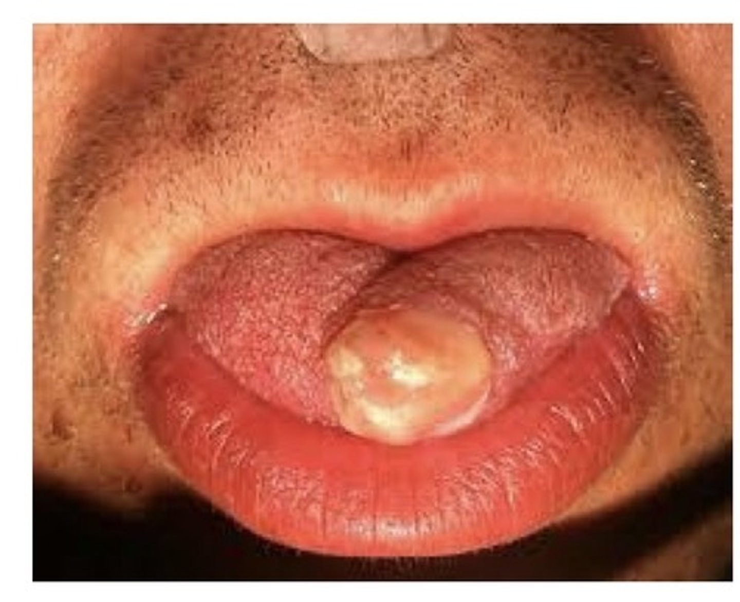 <p>These 2 are benign tumours derived from Schwann cells in nerve tissue. The tongue is the most common intraoral location. May occur at any age, with no sex predilection.</p>