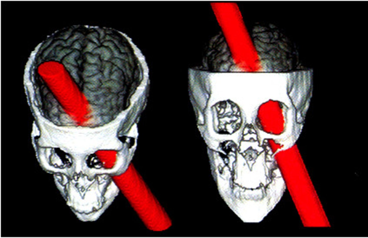 <p>He survived a brain injury in which an iron rod passed through his skull, damaging his frontal lobe. His personality changed, becoming more impulsive and aggressive."},</p>