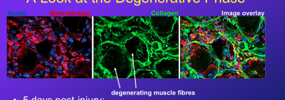 <p>-at 5 days post injury, the macrophages are swarming around badly damaged muscle fibres</p><p>-but the collagen cytoskeleton is relatively intact even in severe damage</p><ul><li><p>this also includes <strong>the endomysium and the basement membrane</strong>, so basically acts as scaffold for new fibres to generate within and in between</p></li></ul>
