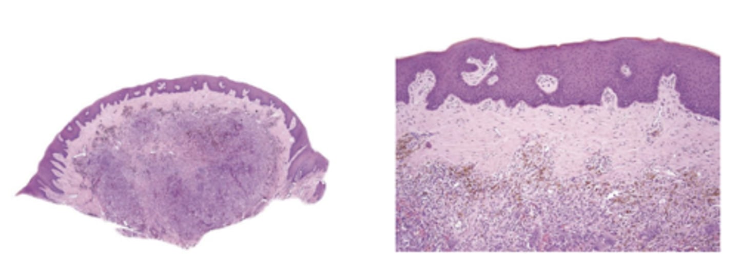 <p>What type of deposit is shown on this histology?</p>