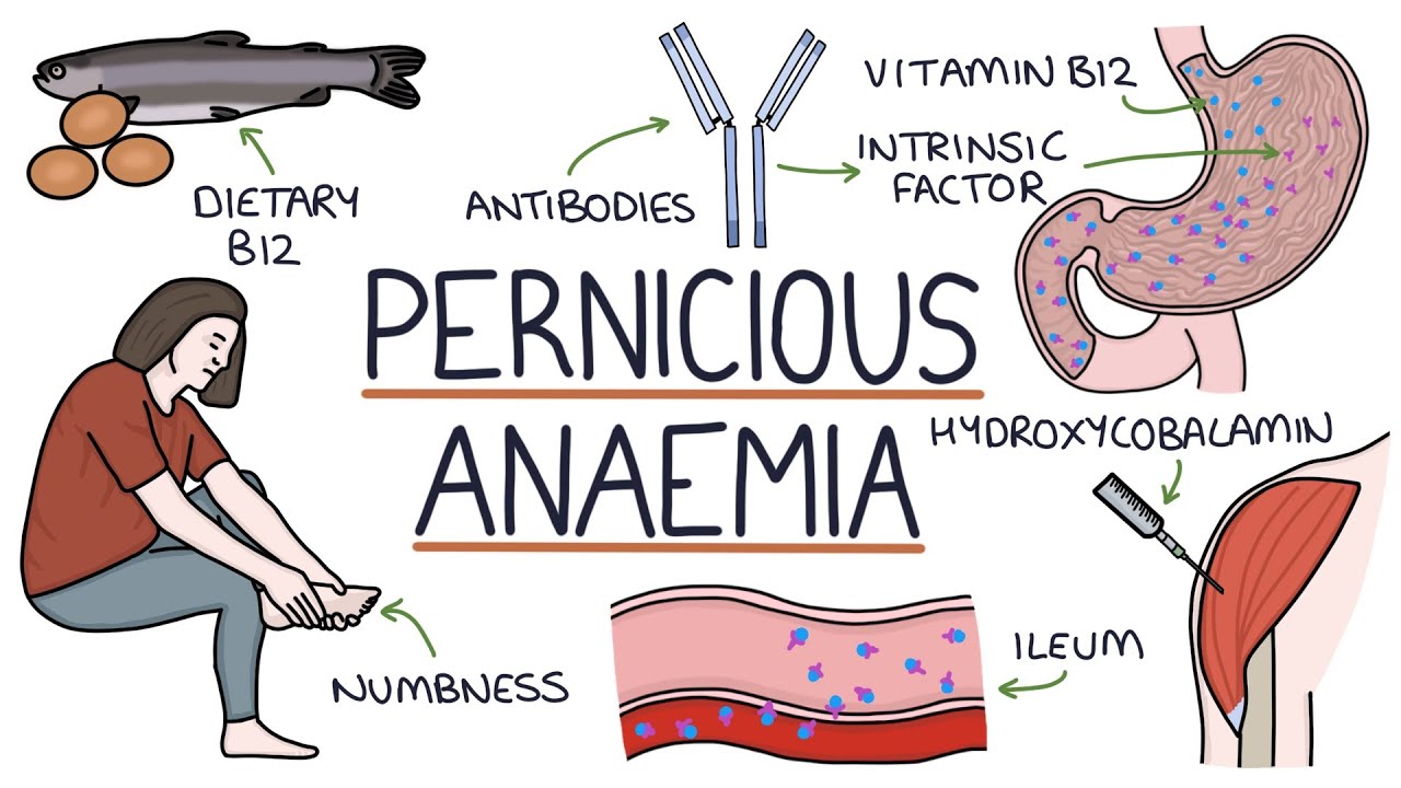 <p>Pernicious anemia</p>