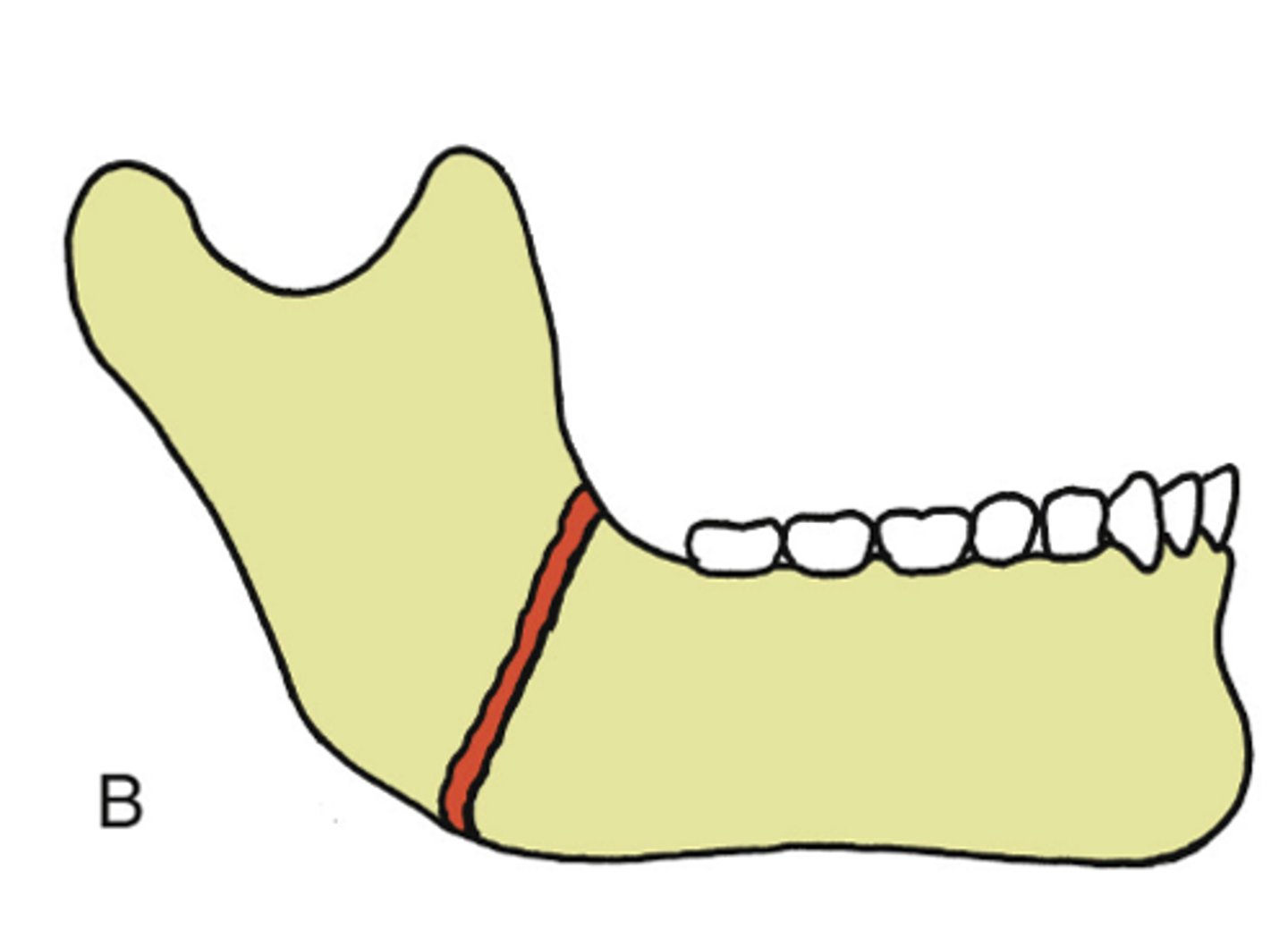 <p>ID the type of mandibular fracture:</p><p>•complete fracture with little fragmentation</p><p>•"A clean break"</p>