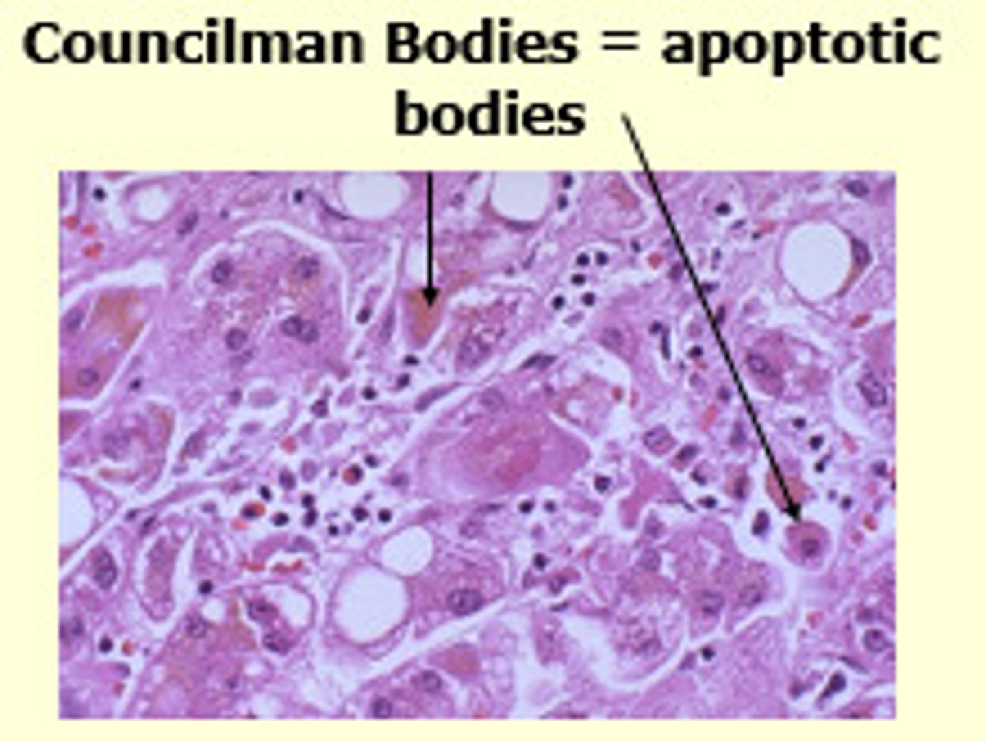 <p>vesicles containing cell contents that are released from a dying cell during apoptosis and engulfed by phagocytes</p>