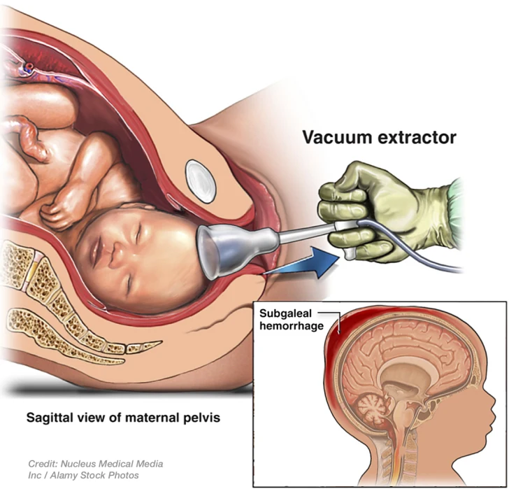 <p>-cap like suction device is applied to the fetal head to facilitate extraction</p><p></p>