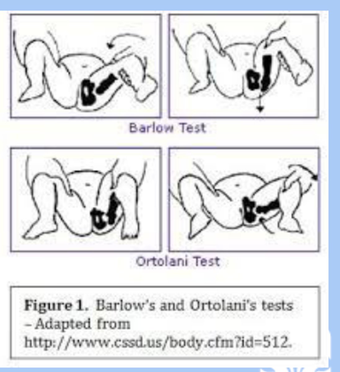 <p>-abnormal relationship between the proximal femur and the acetabulum exists </p><p>-major risks: first born, female, breech position, family hx of DDH </p><p>-sx: asymmetric skin folds, asymmetric knee, barlow's sign, ortolani's sign, painless limp, trendelenburg sign (dip in pelvis), bilateral DDH </p><p>-dx: ultrasonography, high risk screened for DDH w US at 6 weeks, if normal XR follow up at 6mon </p><p>-tx: orthopedic surgery</p>