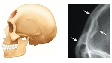 <p>Broken bone portion is pressed inward. Typical of skull fracture</p>