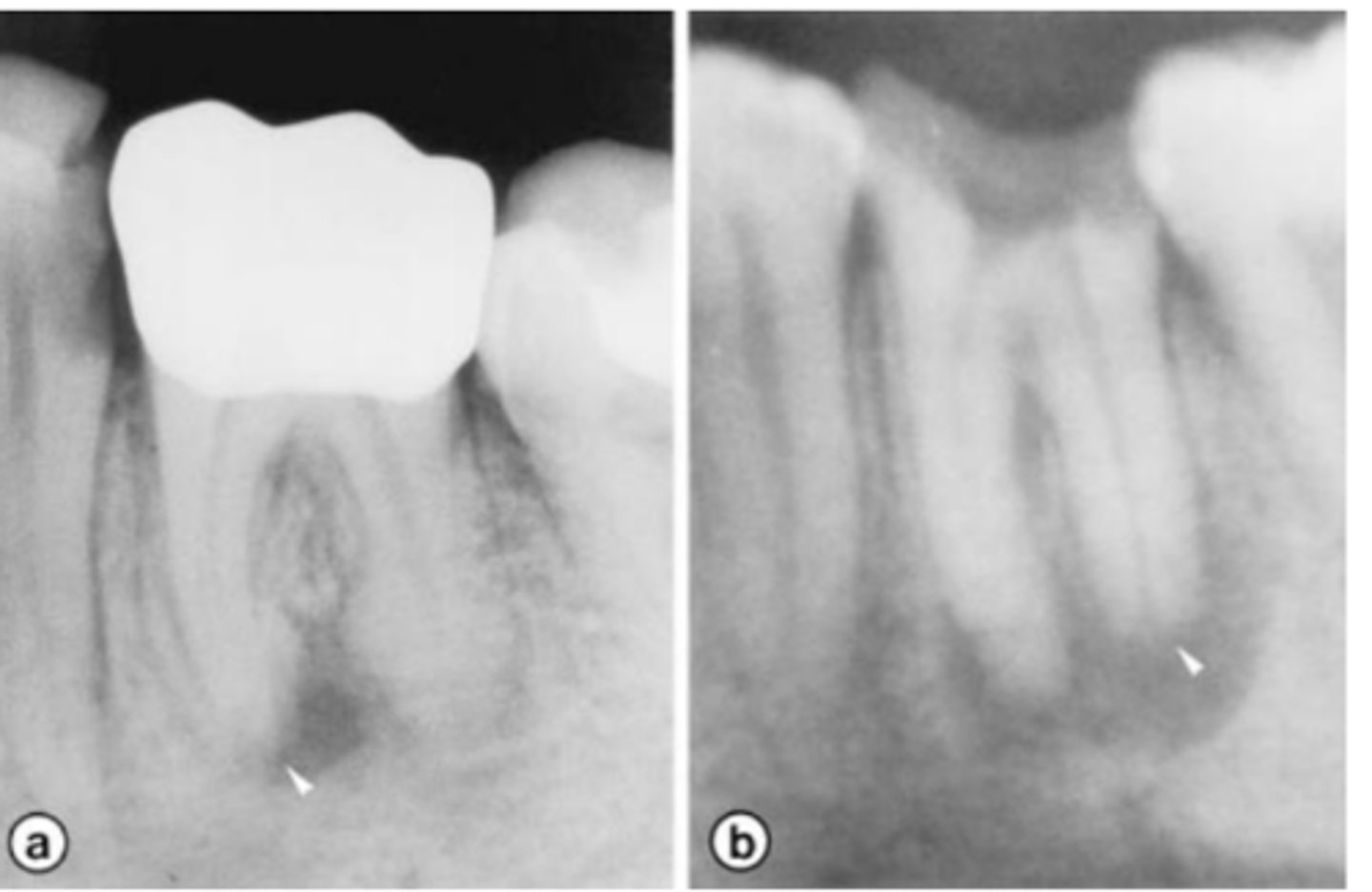 <p>Patient presents with a heavily restored tooth or carious tooth, does not respond to sensibility tests (necrotic pulp) and may be tender to percussion and/or palpation. Radiographs show<strong> roots shorter than normally expected/ragged root ends</strong>. A PARL is also observed. What is the most likely diagnosis?</p>