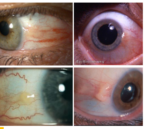 <ol><li><p>Localized, yellow-gray, slightly elevated lesion</p></li><li><p> • Unilateral or bilateral </p></li><li><p><u>• Location: nasal and temporal near limbus</u></p></li></ol><p></p>
