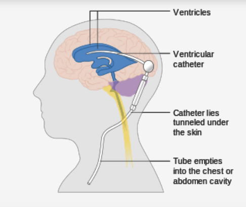 <p><span>HA, Nausea, Vomiting, decreased/altered vision, altered level of consciousness, altered cognition</span></p><p><span>may require a drain or shunt → Not done by PT </span></p>