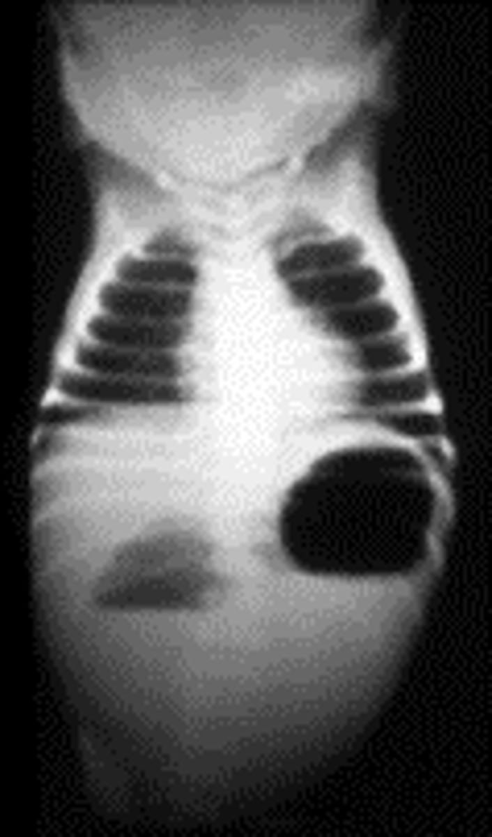 <p>2wk old infant w/ bileous vomiting. The pregnancy was complicated by poly- hydramnios.</p><p>- Assoc w/?</p>