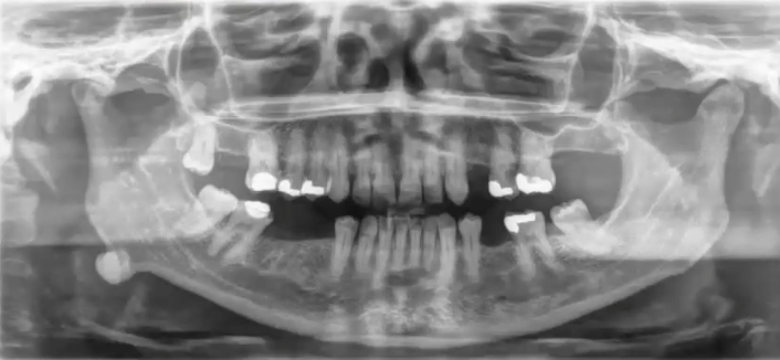 <p>well circumscribed radiopaque lesion in angle of mandible, diagnosis? </p>