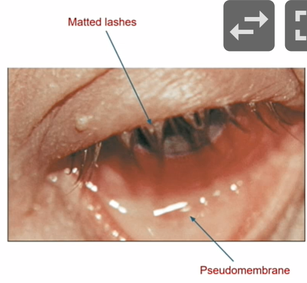 <ol><li><p>matted lashes </p></li><li><p>diffuse hyperemia/ conj hemes </p></li><li><p><strong><u>follicular rxn </u></strong></p></li><li><p>lid edema </p></li><li><p><strong><u>pseudo membranes </u></strong></p></li><li><p>tearing </p></li><li><p><strong><mark data-color="yellow" style="background-color: yellow; color: inherit"><u>sub epithelial infiltrates </u></mark></strong></p></li></ol><p></p>