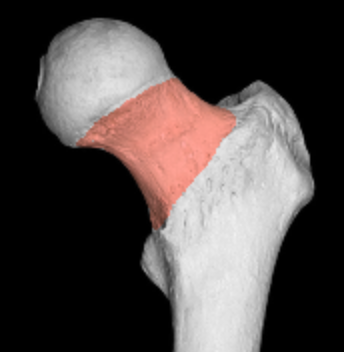 <p>constriction at proximal end of femur</p><p></p><p>lateral to head </p>