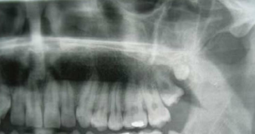 <p>type of hyperdontia </p>