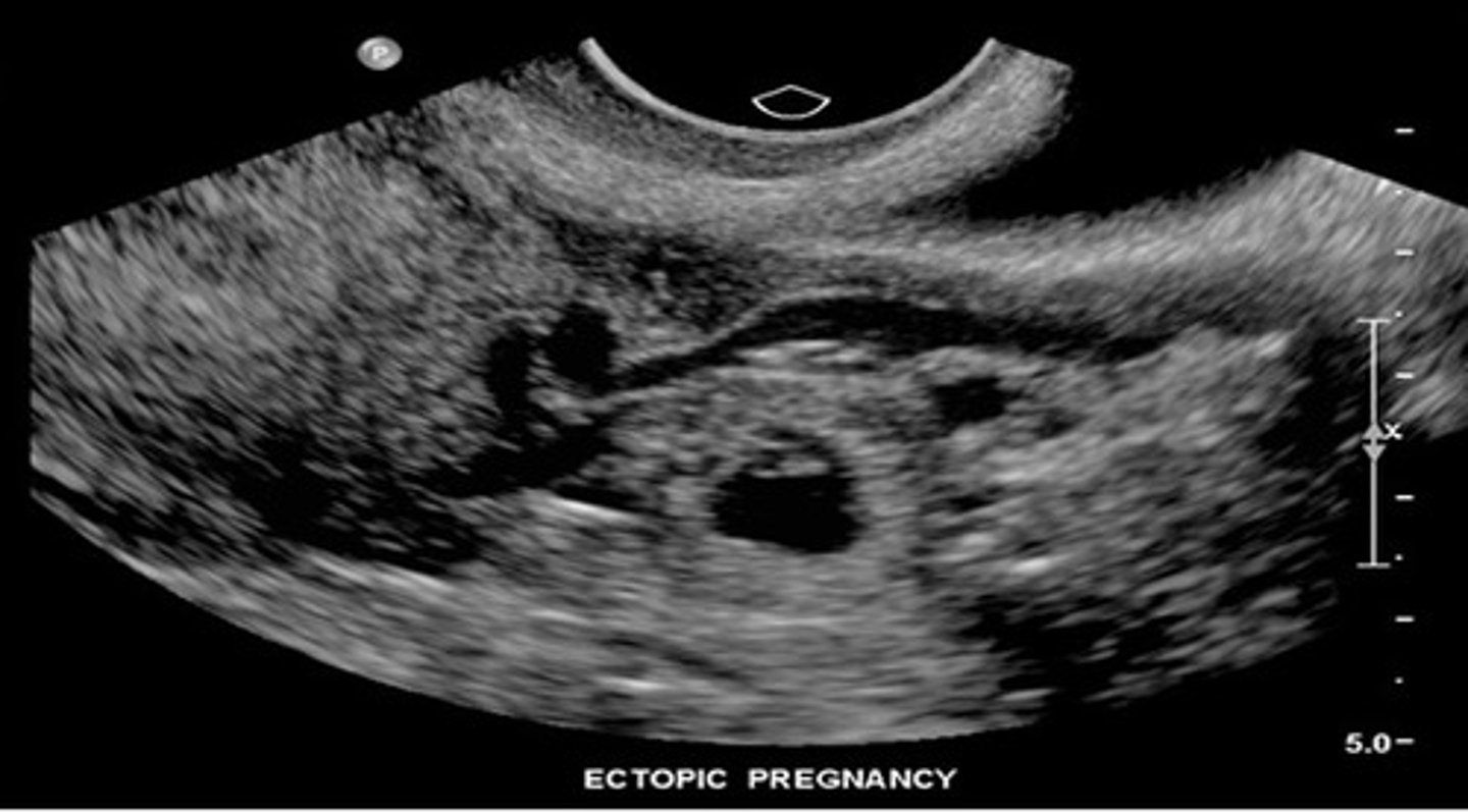 <p>ectopic pregnancy</p>
