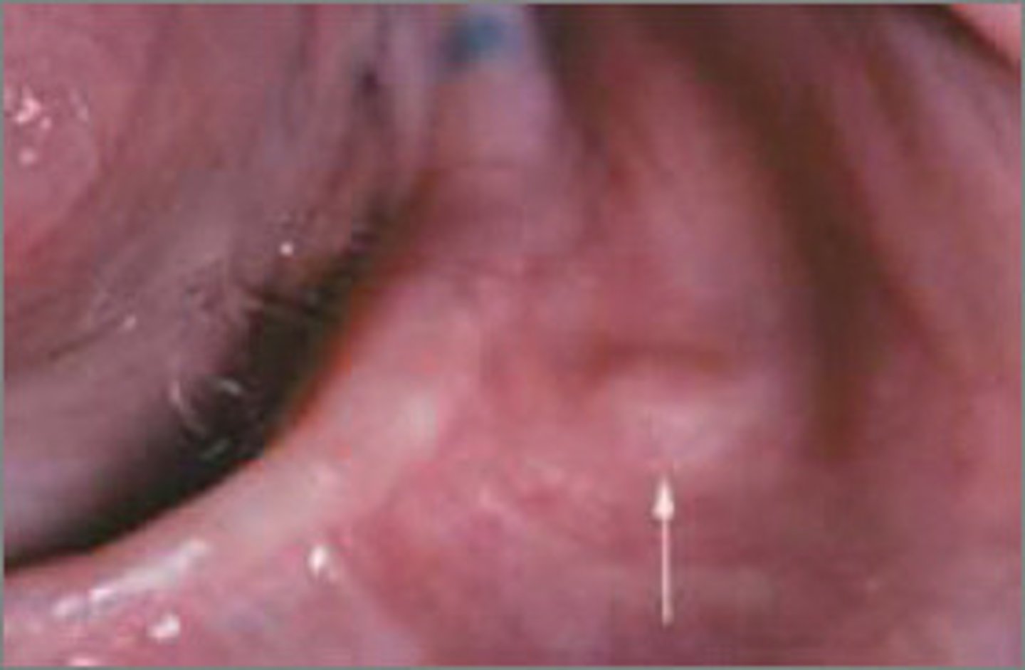 <p>Lesion caused by injury to a peripheral nerve; Painful, ranging from pain on palpation to severe, intractable pain</p>