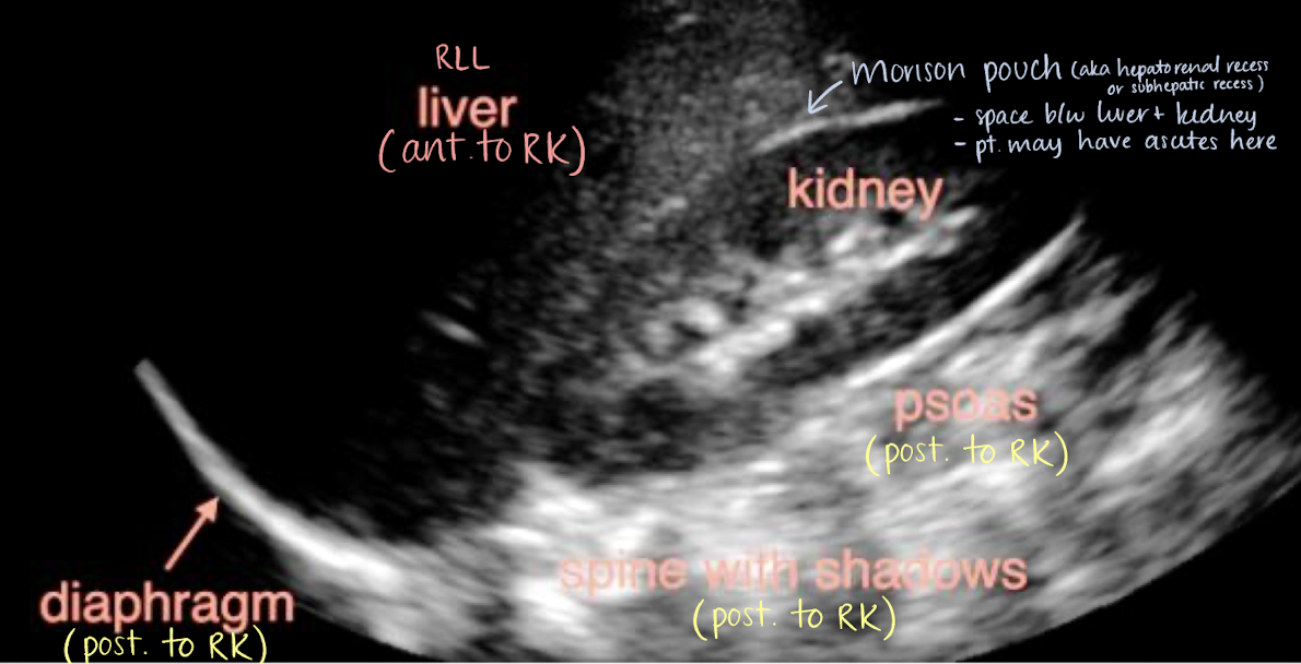 <p>anterior to RK</p><ul><li><p>right adrenal gland</p></li><li><p>RLL</p></li><li><p><mark data-color="yellow" style="background-color: yellow; color: inherit;">Morison’s pouch</mark></p></li><li><p><u>2nd part of duodenum</u></p></li><li><p><u>hepatic</u> flexure of colon</p></li></ul><p>anterior to LK</p><ul><li><p>left adrenal gland</p></li><li><p><u>splenic</u> flexure of colon</p></li><li><p><u>coils of jejunum</u> </p></li></ul><p></p>