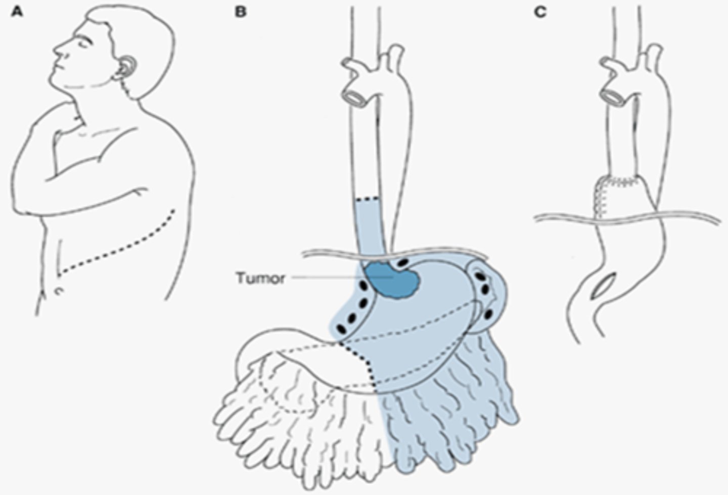 <p>pull stomach up &amp; use as conduit more so than digestive organ--&gt; add chest tube or pigtail catheter--&gt; re-expand lung and ensure no leak from anastomoses--&gt; swallow study (no leak- can remove tube)</p><p>removal is of blue pt in picture </p>