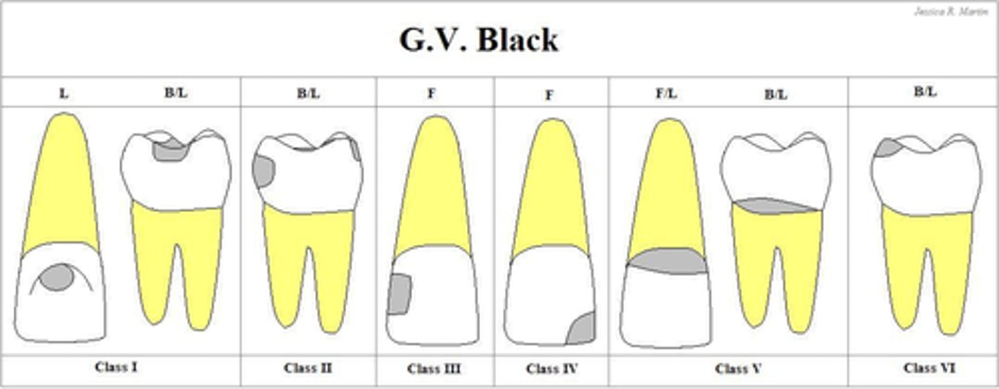 <p>GV Black Classification of Caries:</p><p>Class I</p><p>Class II</p><p>Class III</p><p>Class IV</p><p>Class V</p>