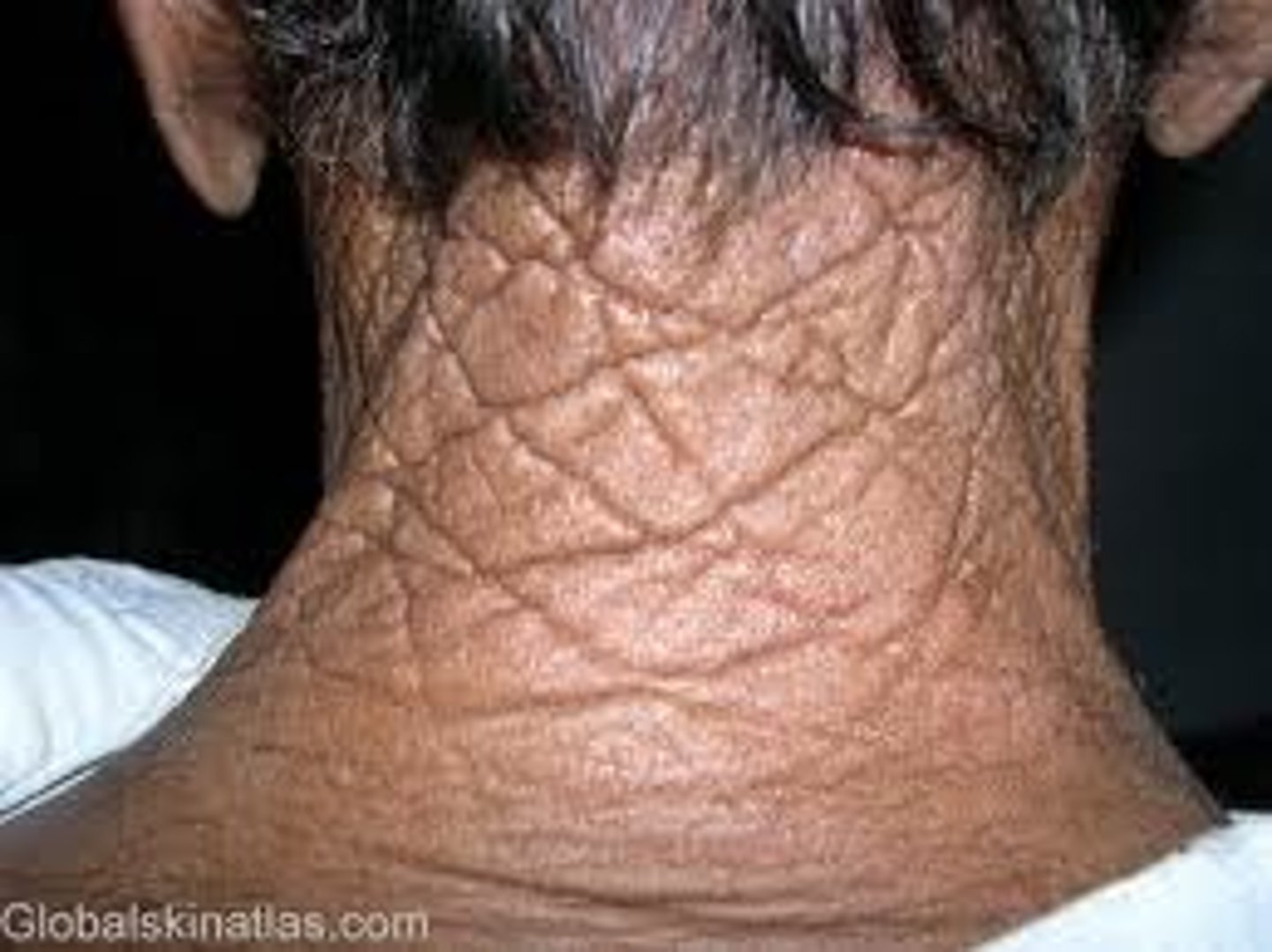 <p>Worn leathery look to the posterior neck from frequent sun exposure</p>