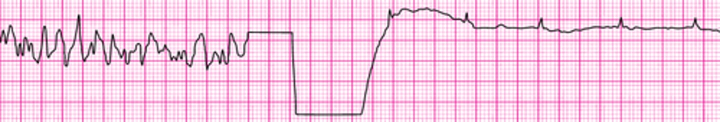 <p>VF with successful defib and resumption of organized rhythm</p>