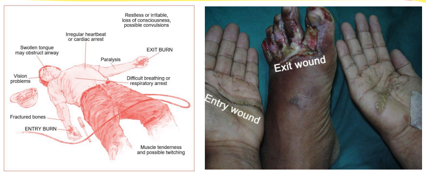 <p>In electrical burns, an electrical current will travel through the body from one point to another, creating “<strong>entry</strong>” or “<strong>exit</strong>” points.</p><ul><li><p><em>Type of current</em></p></li><li><p><em>Intensity of the current</em></p></li><li><p><em>Area of the body that the current passes through</em></p></li></ul><p></p>