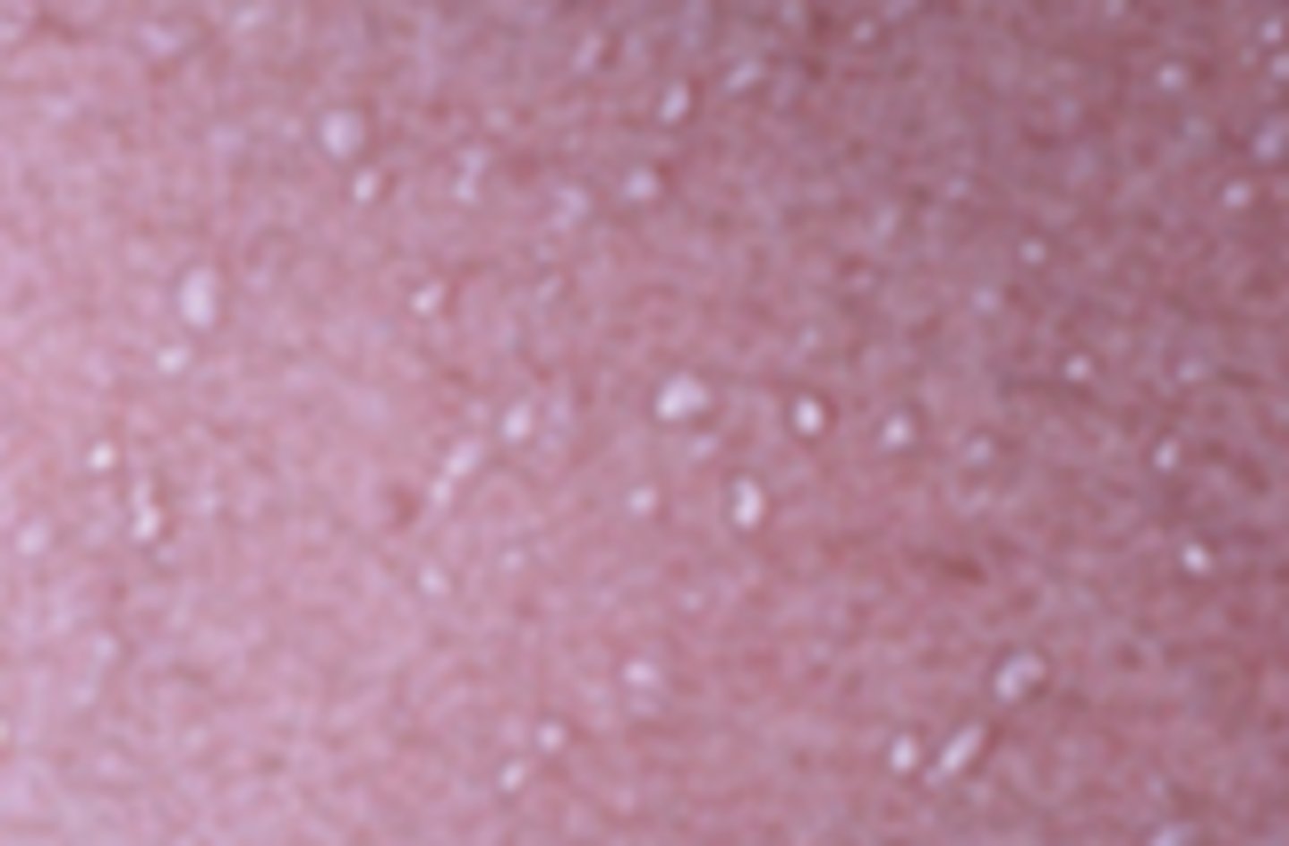 <p>sweat grand obstruction in epidermis</p>
