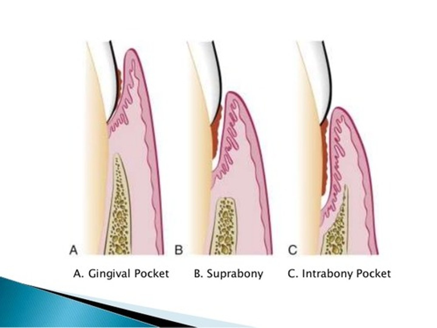 <p>The pocket is located above the level of the bone, NOT visible on a radiograph.</p>