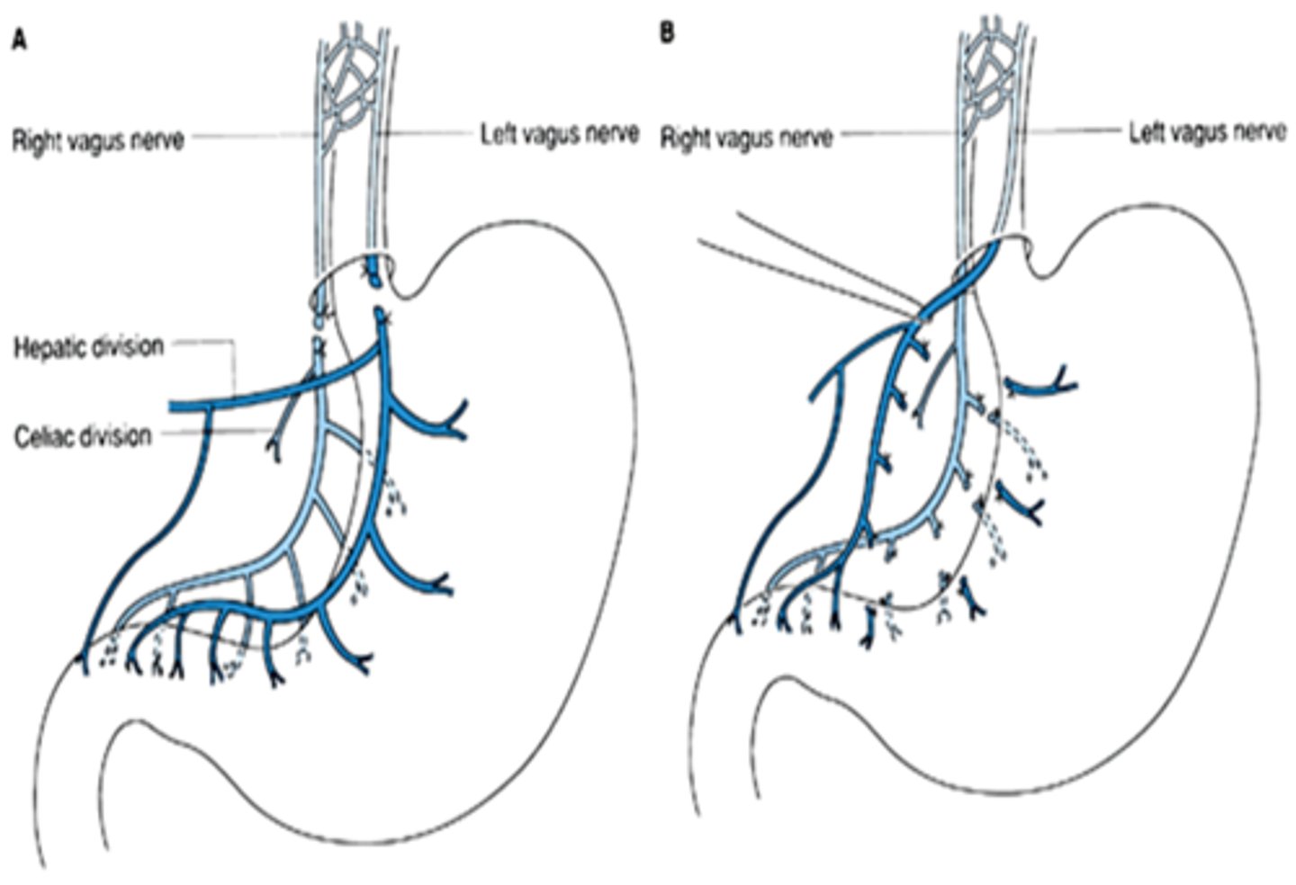 <p>proximal gastric vagotomy</p>