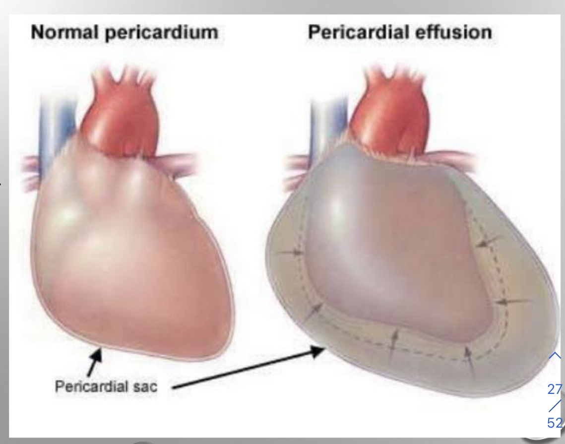 <ul><li><p>pericardial effusion</p></li><li><p>fluid in pericardium</p><ul><li><p>heart isn’t big its the fluid surrounding it</p></li><li><p>heart cant pump with fluid around it</p></li></ul></li><li><p>most common cause is neoplasia</p><ul><li><p>rodenticide</p></li><li><p>idiopathic</p></li><li><p>cancer</p></li><li><p>more common a tumor</p></li></ul></li><li><p>can cause cardiac tamponade</p><ul><li><p>decreased venous return</p></li><li><p>ventricular filling</p></li><li><p>cardiac output</p></li></ul></li><li><p>results in cardiogenic shock</p></li></ul>