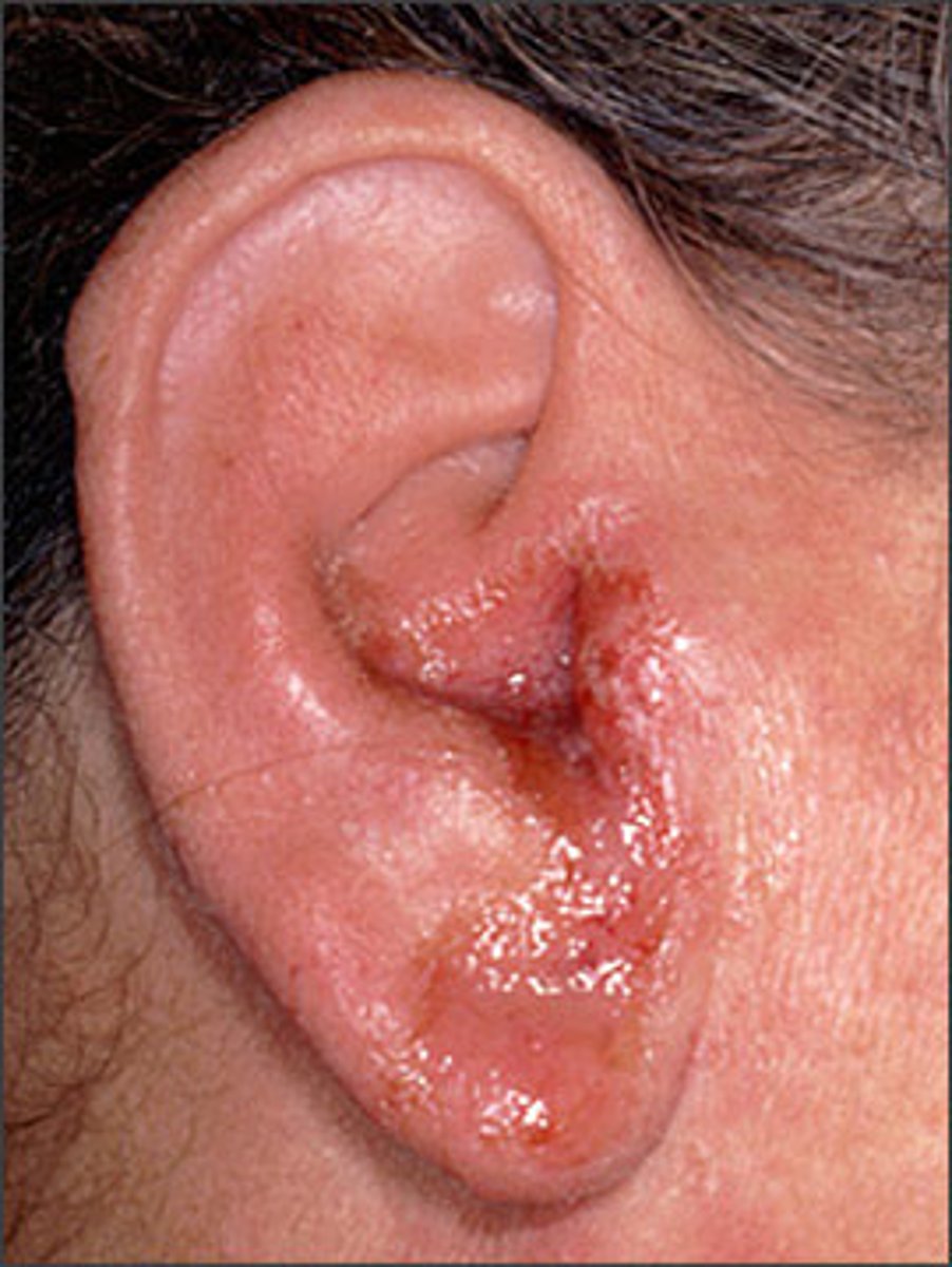 <p>-swollen ear canal, moist and erythematous</p><p>-drainage known as otorrhea</p><p>ask if they've swam recently</p>