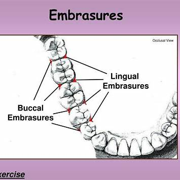 <p>Facial embrasures are generally narrower than lingual embrasures. The curvature of teeth are typically more pronounced on the lingual side, allowing for a larger embrasure.</p><p class=""></p>