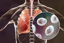 <ol><li><p>Humans with <strong><em><mark data-color="blue" style="background-color: blue; color: inherit"><u>depressed T cell immunity </u></mark></em></strong>→ TH1 response plays major role</p></li><li><p><strong><em><mark data-color="yellow" style="background-color: yellow; color: inherit">Pneumonia</mark></em></strong> → dyspnea and hypoxia → nonproductive cough</p></li><li><p>Extrapulmonary lesions in ADVANCED AIDS</p></li></ol><p></p>