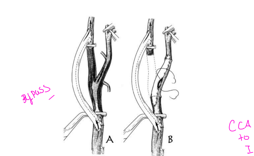 <p>Underlying and unstable disease</p><p>conditions</p><p> Poor circulation distally</p><p> Poor inflow disease</p><p>Types</p><p> CCA to CCA ipsilateral</p><p> CCA to ICA ipsilateral</p><p> CCA to CCA contralateral</p>