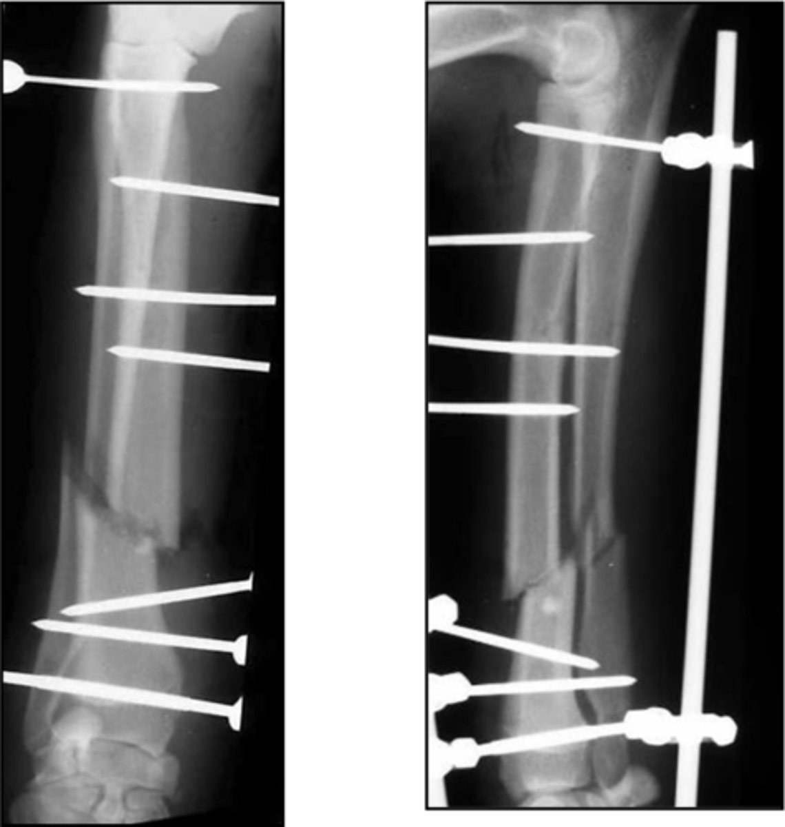 <p>-uniplanar or biplanar</p><p>-unilateral or bilateral</p>