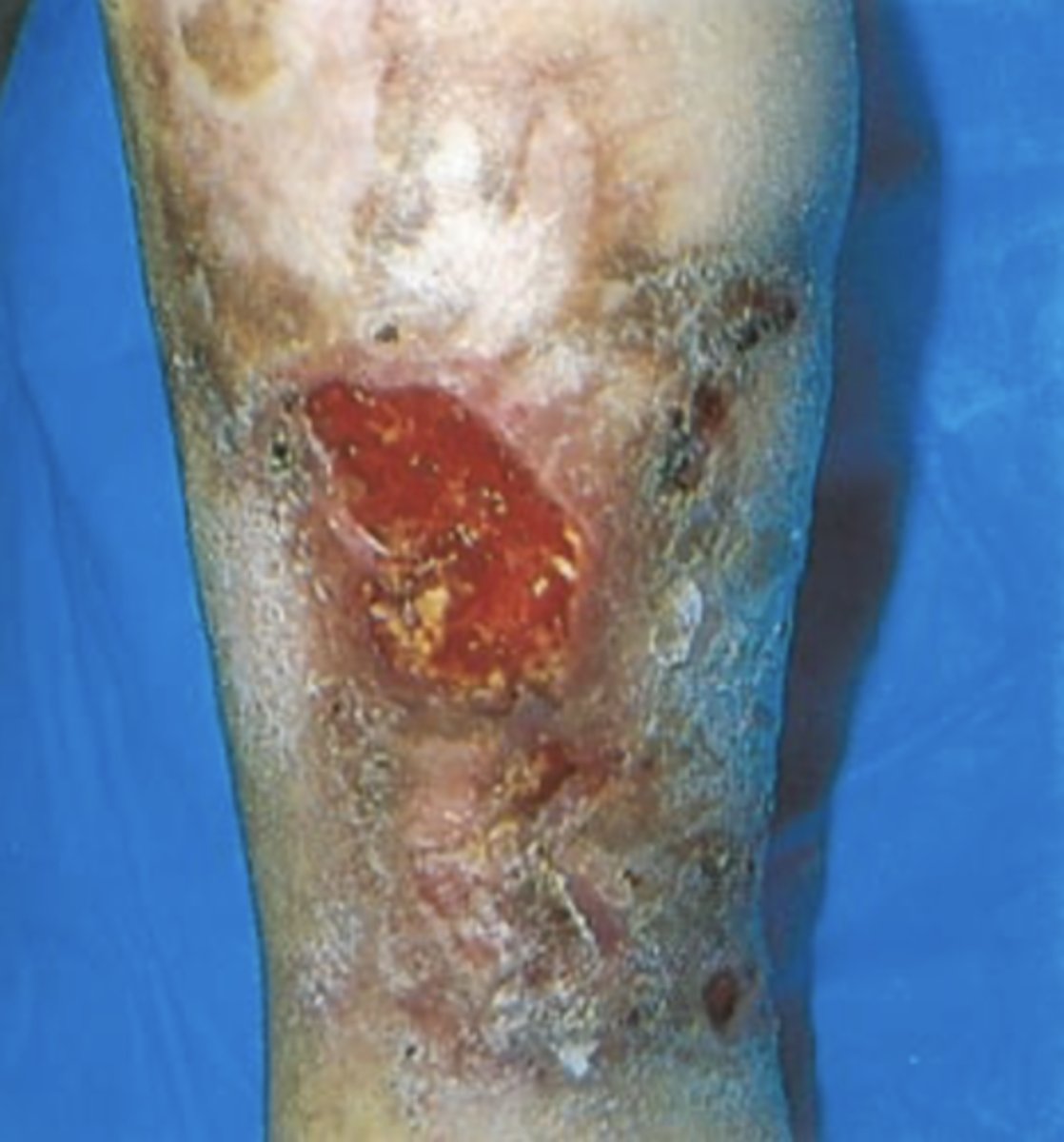 <p>- Ulcerations that occur after acute DVT or with chronic incompetent valves in deep veins</p><p>- Occur at medial malleolus</p><p>- Characterized by bleeding and uneven edges</p><p>- Brown discolouration can occur if chronic</p>