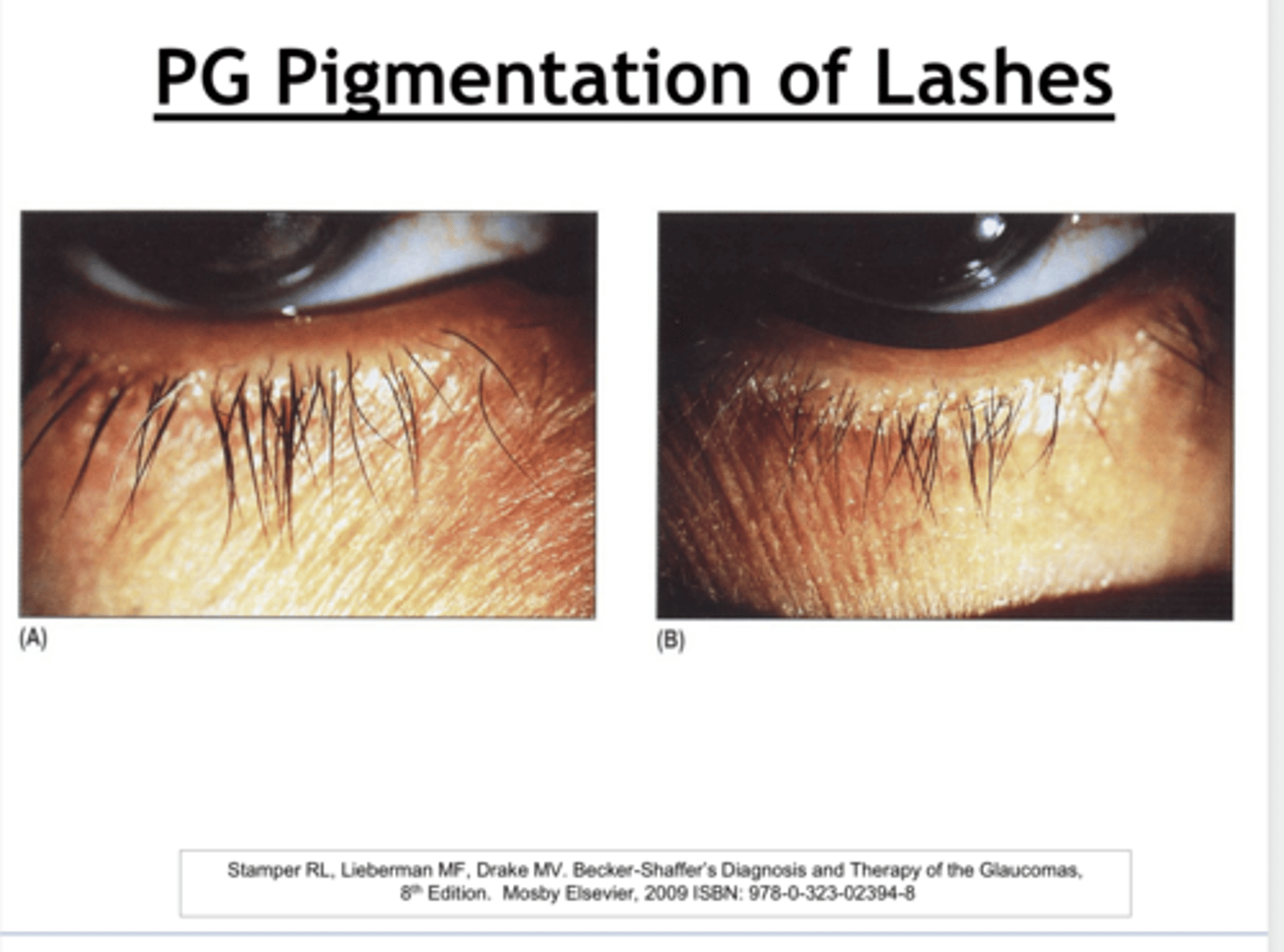 <p>Is the pigmentation and growth of the eyelashes with prostaglandin use permanent or temporary?</p>