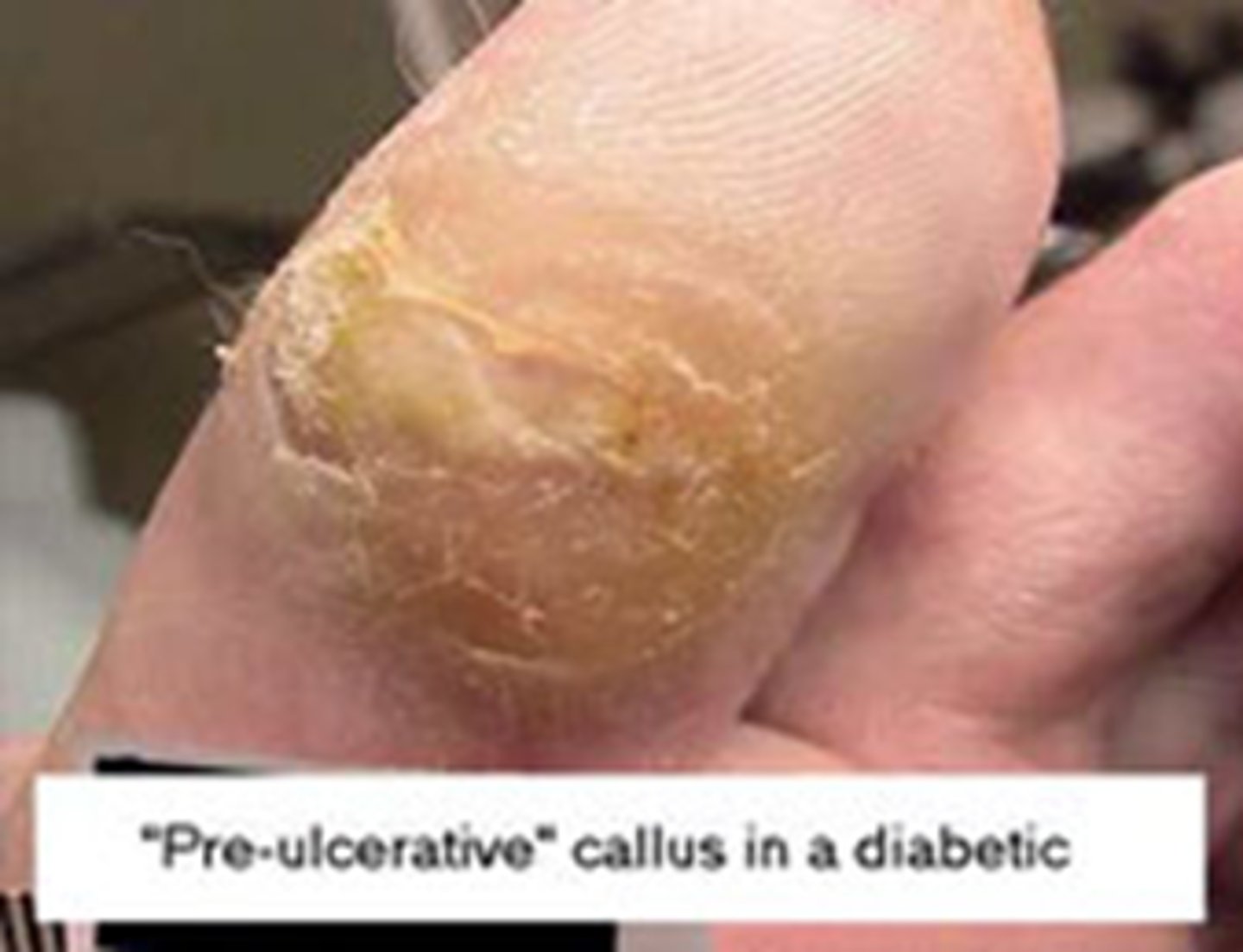 <p>no open ulcerations but possible existence of bone deformation or hyperkeratosis</p>