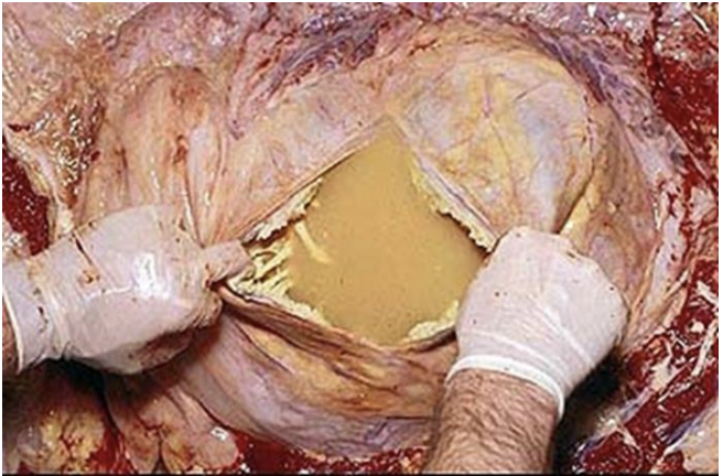 <p>exudate</p>